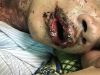 Dị ứng thuốc gây ra Hội chứng Lyell